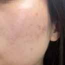 솔케어 | 솔에스테틱 대구점에서 여드름케어 받은 후기