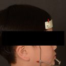 페이스라인치과의원 | 거꾸로 물리는 앞니, 페이스마스크로 해결. 실제 후기로 보는 어린이 주걱턱 교정 시기