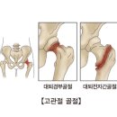 병리적 골절[Pathological fracture]근골격질환 이미지