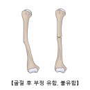 골절후 부정유합,불유합 (Malunion & nonunion of fracture)근 골격질환 이란? 이미지