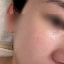 순천 피부관리 에스테틱 벨리노 40 RF고주파 후기