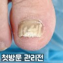 여자발톱무좀 발관리샵 후기? 무좀 고치고 싶은 분만 보세요.