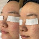 천사희망케어 | 내돈내산 세종시 여드름성 피부 관리에는 연에스테틱 찐 후기