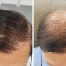 모자티헤어증모