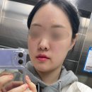서울의원 | 내돈내산 서울 사려니의원 편평사마귀 제거 당일 후기 주의사항