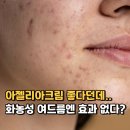 보고약국 | 아젤리아크림 파는곳 어디? 약국 가격 보고 놀란 이유와 부작용 후기