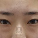 디바인성형외과의원 | 눈밑지방재배치, 수술 후기 보여드립니다.