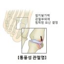 통풍 (Gout) 이미지