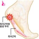족저근막염(Plantar Fasciitis)의 이해 족저근막이란? 이미지