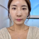 자연 + 인간 + | 부산 대연동피부과 텐써마 300샷 브이로 고현정리프팅 후기