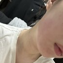 지영이네감자탕 | 턱뼈 골절 후기(?) - 4주차
