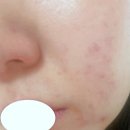 1004네 | 스킨1004 센텔라 앰플 여드름 피부관리 후기