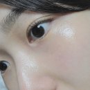 광피부과의원 | 건대 피부과 엑소좀 엑소라인 리파인 MTS 후기(당일, 통증, 효과)