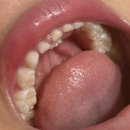 하남새이치과의원 | 하남미사 치과 방문 7살 영구치를 위한 유치 발치와 충치 치료 후기