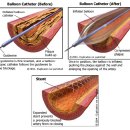 카테터(catheter) 이미지