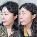 본병원 | 아프지 않은 윤곽 리프팅 압구정 리프팅 병원 인어젯 받아본 후기