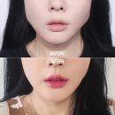 더 준 | 강남 울쎄라300샷 + 턱 보톡스로 얼굴형 관리 받고 완전 달라진 후기!
