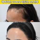 [20대 여자 M자 이마 비절개 모발이식 후기] 무삭발 히든컷 2700모 1년 변화과정 (모엠의원/헤어라인/전지훈원장) 이미지