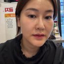 안피부과의원 | 청담피부과 안티안의원 BBL 비비엘히어로 후기, 잡티·탄력·홍조 올인원 관리!