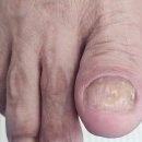 네일크루 | 영천 경주 발톱무좀 두꺼운발톱 해결 후기 재은네일뷰티 페디크루 영천점