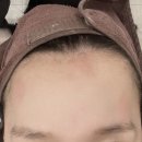 잠실 피부관리 가희하다 꼼꼼한 문제성 홍조피부 진정케어 송파에스테틱 후기