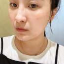 압구정 피부과 쥬베룩볼륨 팔자주름 미간보톡스 내돈내산 후기