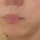 산본 피부과 수염 레이저제모 3회차 내돈내산 후기(범계,젠틀맥스프로플러스 추천)