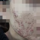 수원지루성피부염 피부과치료 플러스 한의원도 보니까