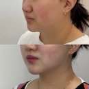 선쥬리 | 광주 남구 진월동 이중턱제거, 쥬리살롱 V컷 솔직후기 (내돈내산)