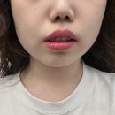 서면피부과에서 반쪽주사 맞고온 솔직후기 브이라인 될 수 있을까