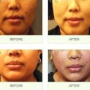 청담미의원 | 청담미 원장님이 권하는 안티에이징 시술 (1탄)