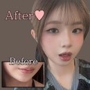 P-7706 | 무턱, 얇은 일술 고민 끝! 입술필러&amp;턱끝필러 후기♥