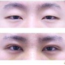 전주 눈밑지방재배치, 전주에서 개원하길 잘~했다~