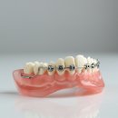 미소핀의원 | 양악수술과정 후 얼굴 변화 3단계 공개