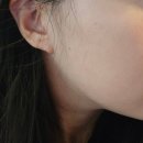 허한의원 | 오랫동안 컴플렉스였던 여드름 패인흉터 제거 시작, 홍대한의원 새살침 후기