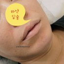 입술 톤 보정+생기 업! 입술 문신 시술 후 후기