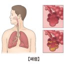 폐렴(Pneumonia)증상 이미지