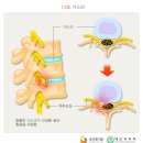 목 디스크 (경추 추간판탈출증) 이미지