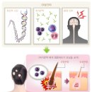 대전 피부과 ; 탈모에 대한 모든 것 (3) ｜원형탈모