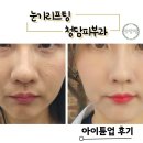자연아이 | 청담피부과 아이튠업 리얼후기 자연스러운 눈가리프팅 관리