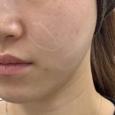 주식회사 다온다옴 | [피부시술] 청담피부과 온다리프팅 + 지방분해주사 볼릿주사 내돈내산 후기