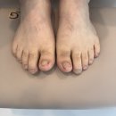 백림마취통증의학과의원 | 동대문 발톱무좀 케어 병원에서 완치 한 후기