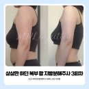 상상만 하던 복부, 팔 3회차 기록 지방분해주사의원 후기