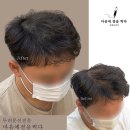 마음에점을찍다두피SMP 이미지