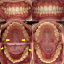 나은치과의원 | 어금니 가위교합 교정, 유지장치 없어 다시 비뚤어진 앞니 재교정 후기. 송파구 교정치과