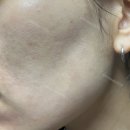 포텐자 쥬베룩 통증 내돈내산 후기 | 모공 시술 재생관리 총정리 2편 (+스킨보톡스 얼마나 아플까)