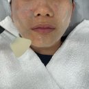 올스킨 | 청주피부관리 강서동에스테틱 여드름압출 후기 올스킨