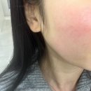 미르피부과의원 | 포텐자 700샷 효과 후기 공유 (feat.픽셀랩)