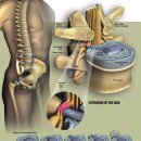 허리디스크 이미지