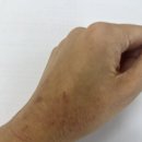 (주)셀트리온제약 | 아토피 면역치료 기록｜아카리작스 설하정 복용 + 히스토불린 주사 6차 후기